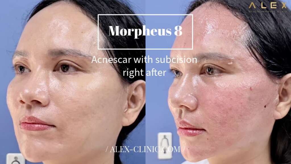 ภาพเปรียบเทียบก่อนหลังทำ Morpheus8 (M8) ร่วมกับ Subcision รักษาหลุมสิว มุมข้าง Dr.Alex Clinic