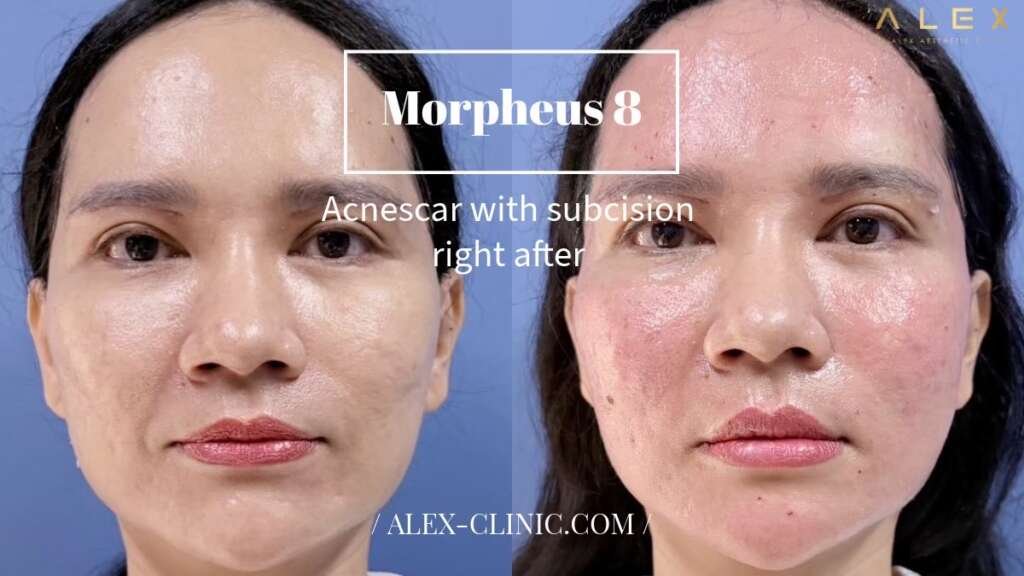 ภาพเปรียบเทียบก่อนหลังทำ Morpheus8 (M8) ร่วมกับ Subcision รักษาหลุมสิว Dr.Alex Clinic